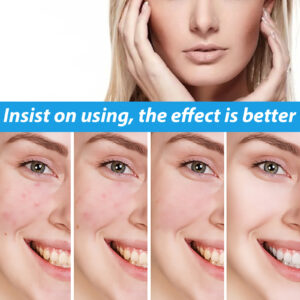 Product image for  Desalting Pimple Spot Emulsion Reduces Closed Mouth Home Décor 13